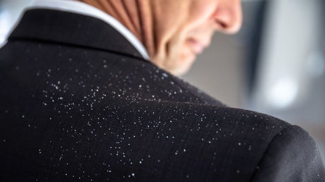 Scapă De Mătreață Și Coji Pe Scalp Cu Tratamente Naturiste Eficiente