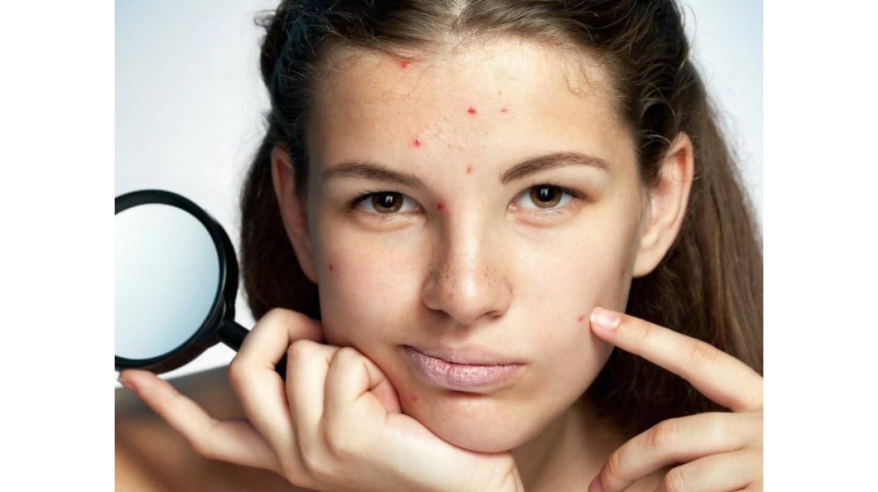 3 Mituri despre acnee pe care le-am crezut adevarate