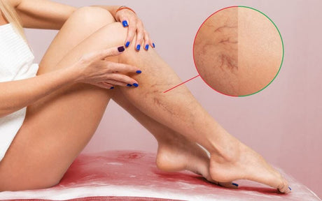 Tratarea varicelor: remedii naturale și prevenție